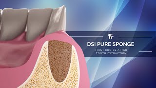 How to prevent a dry socket and bone loss after tooth extraction? Tips For Managing Dry Socket Alveolar Osteitis Onlineexodontia Com