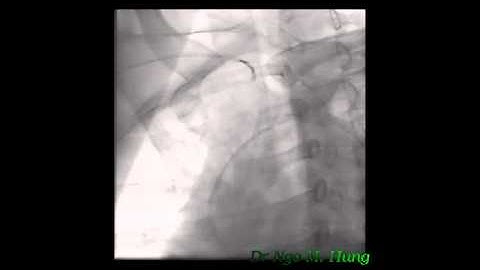 Completely Retrograde Wiring Technique in CTO intervention