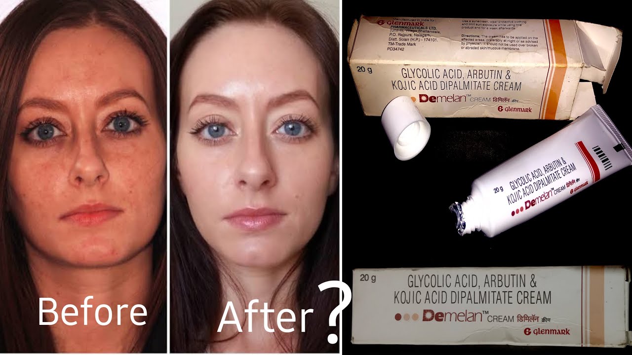 demelan cream for acne scars