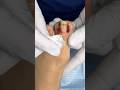 INCREÍBLE cambio posterior a una MATRICECTOMIA #satisfying #ingrown_toenail