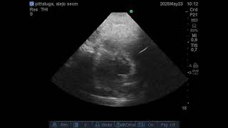 subxifoideo subxifoideo eje corto mitral