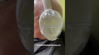 The Otoset is the FIRST FDA cleared earwax removal system. more info at MyAffordableHeaing.com