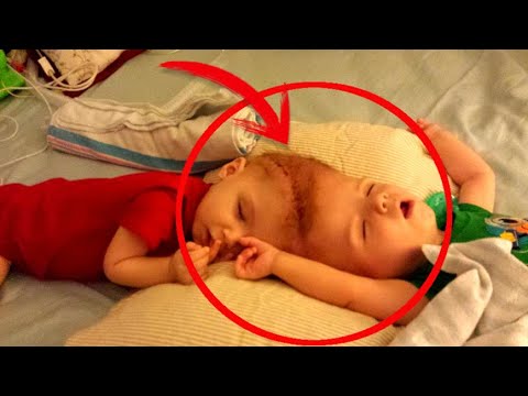 ტყუპები თავებით იყვნენ გადაბმული,ექიმებმა იშვიათი გადაწყვეტილება მიიღეს რაც წარმოუდგენლად დასრულდა..