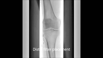 Jetstream atherectomy of diffuse SFA lesion