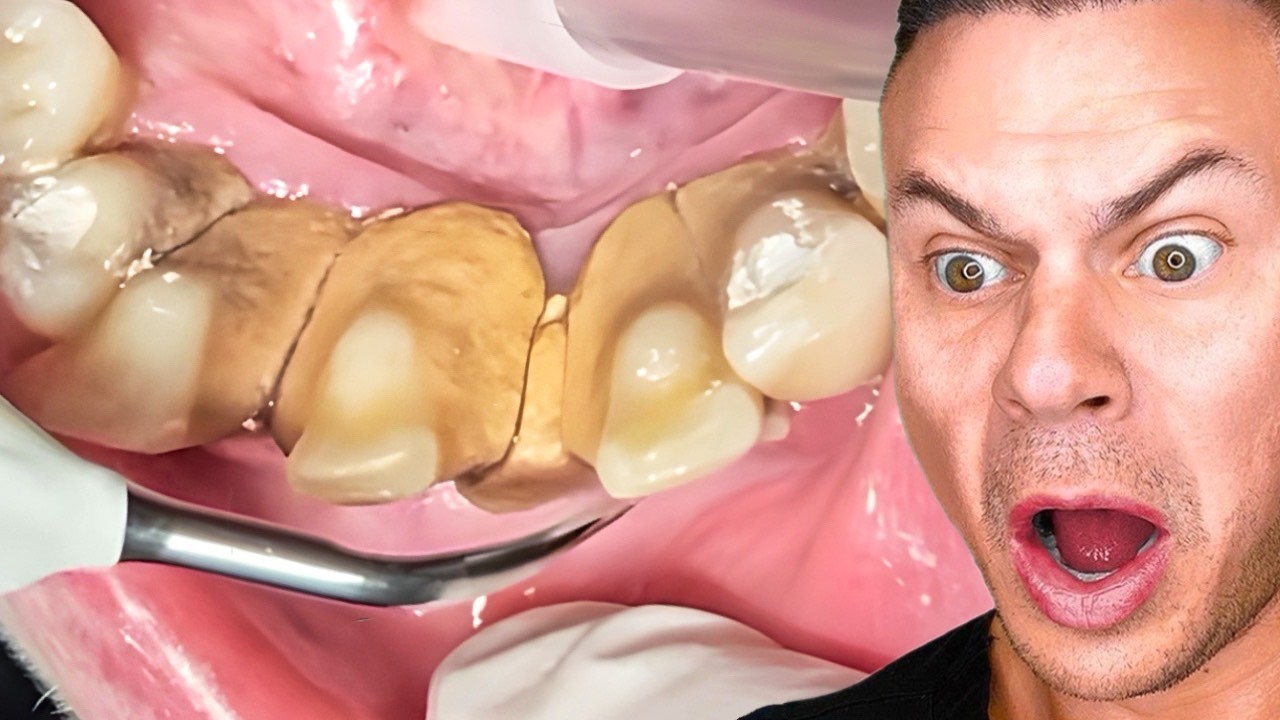 Watching Dental NIGHTMARES So You Don’t Have To