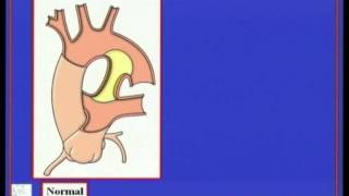 RHA Coarctation&Interruption of aortic arch