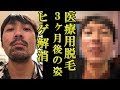 【永久脱毛】医療用脱毛で髭と完全におさらば！レーザー脱毛開始して3ヶ月記録【男性必見】