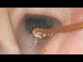 【耳掃除】#160 〜毛、長すぎ(笑)〜 earwax