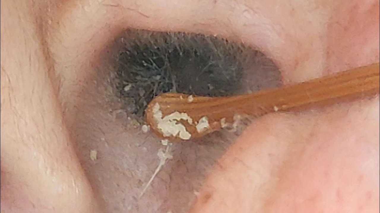 【耳掃除】#160 〜毛、長すぎ(笑)〜 earwax