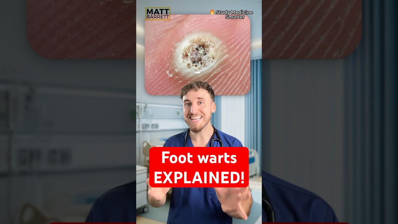 Foot warts explained for your medical exams!