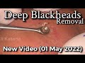 Deep Blackheads Removal With Extractor &amp; Cotton Buds by Dr.Lalit Kasana (01 May 2022)