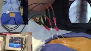 Radiofrequency Ablation Explanation Video Demonstration - LIVE!