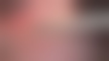 Laparoscopic partial nephrectomy for 11p R.E.N.A.L. score tumor