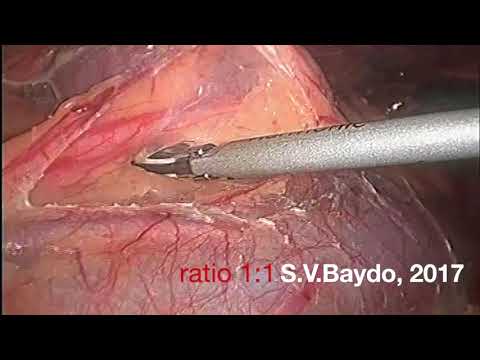 Laparoscopic Partial Nephrectomy For 11p R.E.N.A.L. Score Tumor