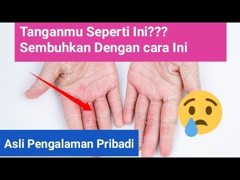 Video: Bagaimana Kanak-kanak Mempunyai Alergi Terhadap Serbuk Cuci