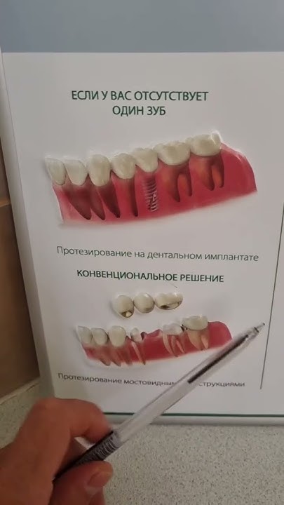 Мост или имплант? Мостовидный протез или имплантация? Что выбрать ...