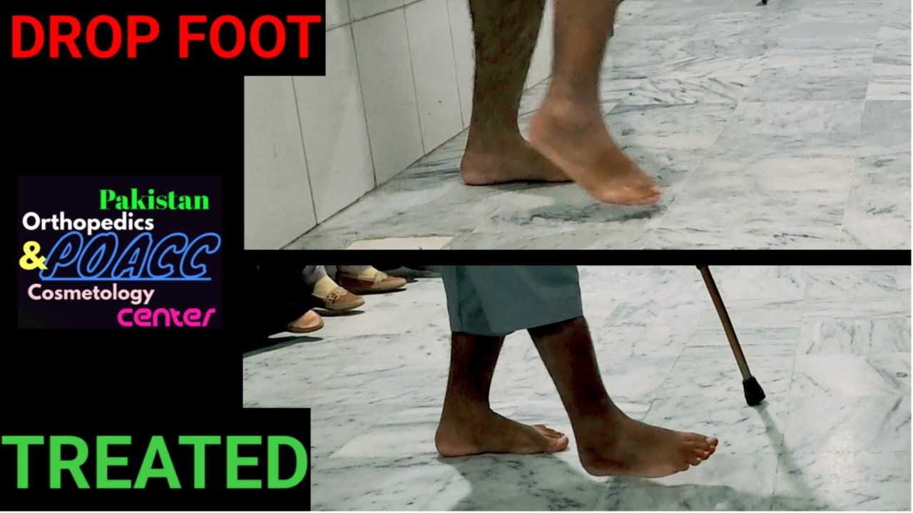 Drop foot Recovery after Tendon Transfers / Before and After / Side view walking gait