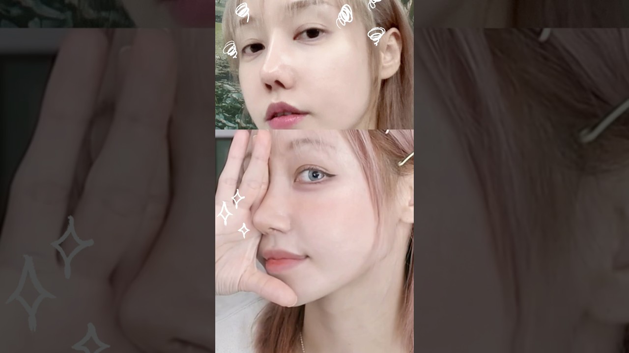 드디어ㅠㅠ 망한 코재수술 성공하뮤ㅠㅠㅠ✨