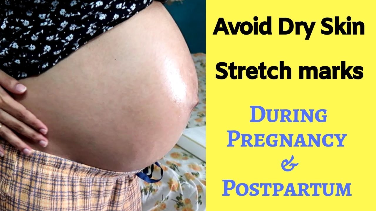 How To Prevent Stretch Mark During And Post Pregnancy Youtube 