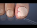 Ingrown toenail removal treatment  paronychiaparonychie ingrown toenailonychocryptosis