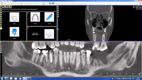 Reconstructed Panoramic image with CBCT Cone Beam Trium and WhiteFox