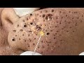 Blackhead removal with sac dep spa 10006969