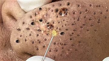 Blackhead Removal With Sac Dep Spa @10006969