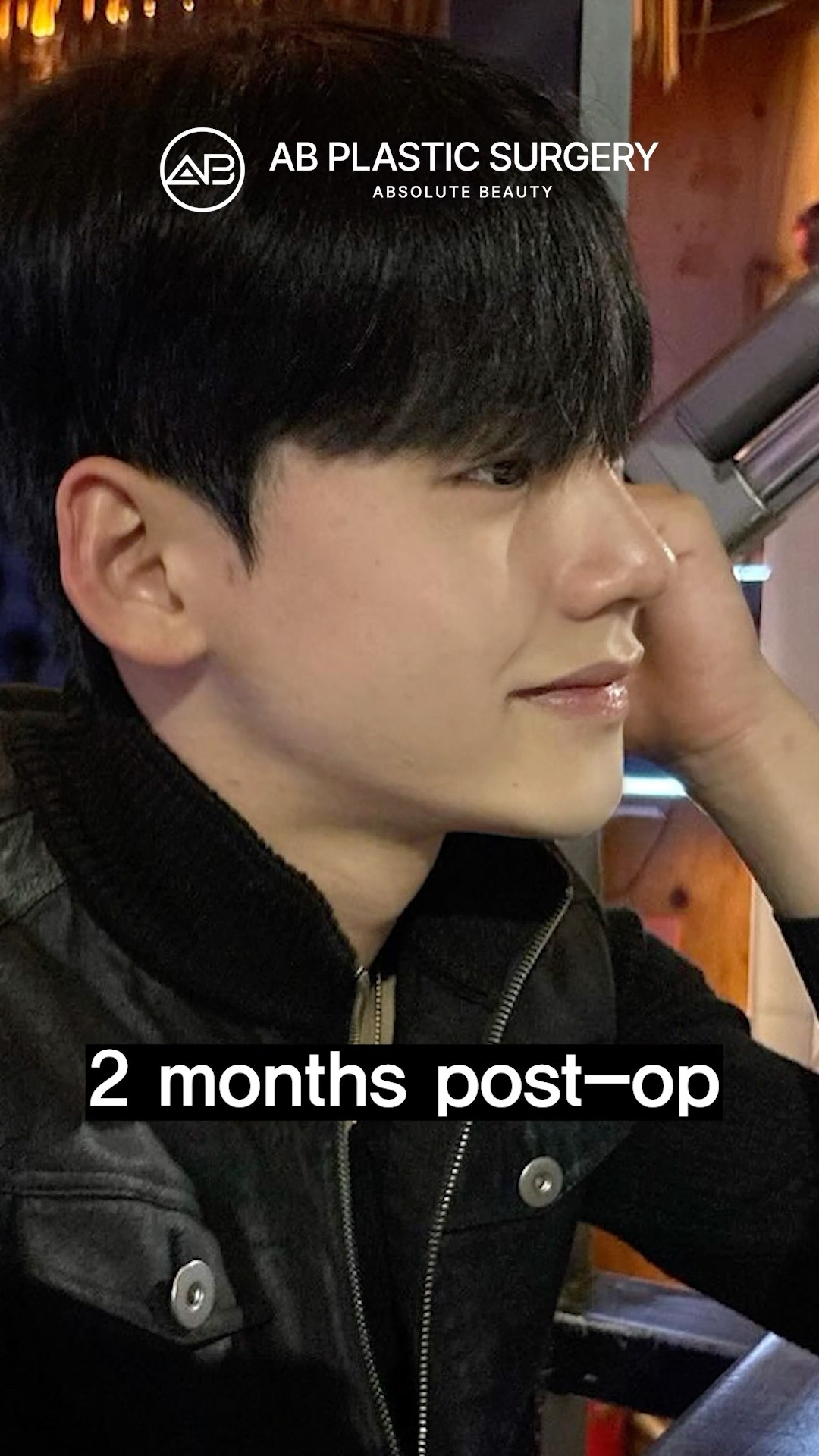 Male Nose Job Consultation & Results #koreanplasticsurgery