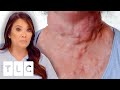 Dr. Lee Removes At Least 20 Cysts From Patient’s Neck! I Dr. Pimple Popper: This Is Zit