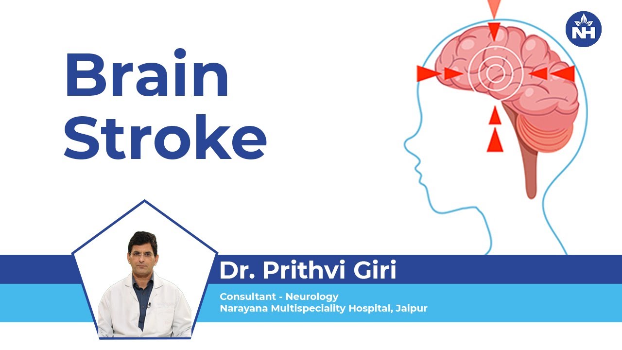 Brain Stroke Symptoms & Treatment Dr. Prithvi Giri (Hindi) YouTube