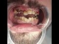 #fullmouthrehabilitation