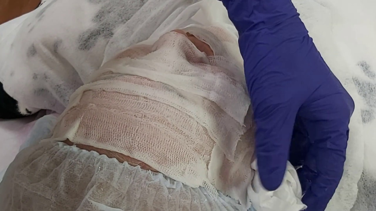 Увлажняющая процедура с ГК через 10 дней после пилинга ТСА.