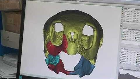 Terminator turtle gets a 3D printed titanium jaw