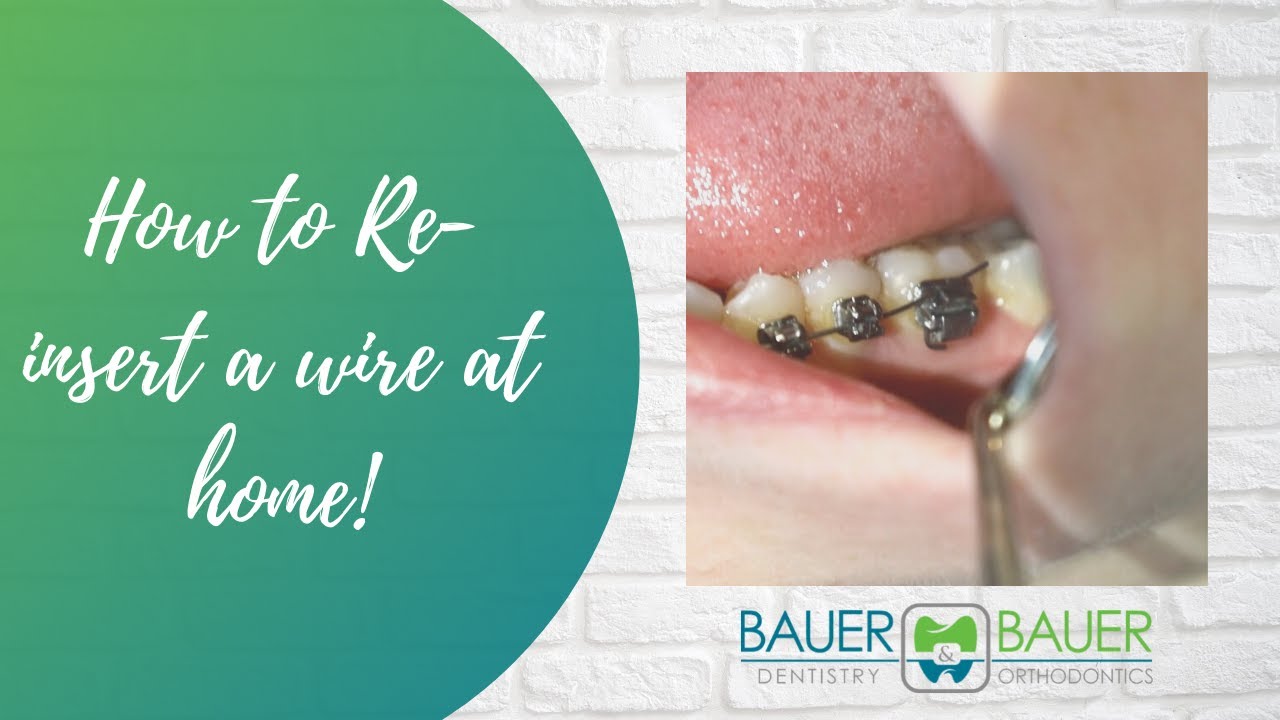 How to Handle Pokey Wires and Home and Other Orthodontic Tips - Belmar  Orthodontics