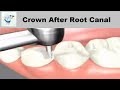 Dental Crown Procedure After Root Canal