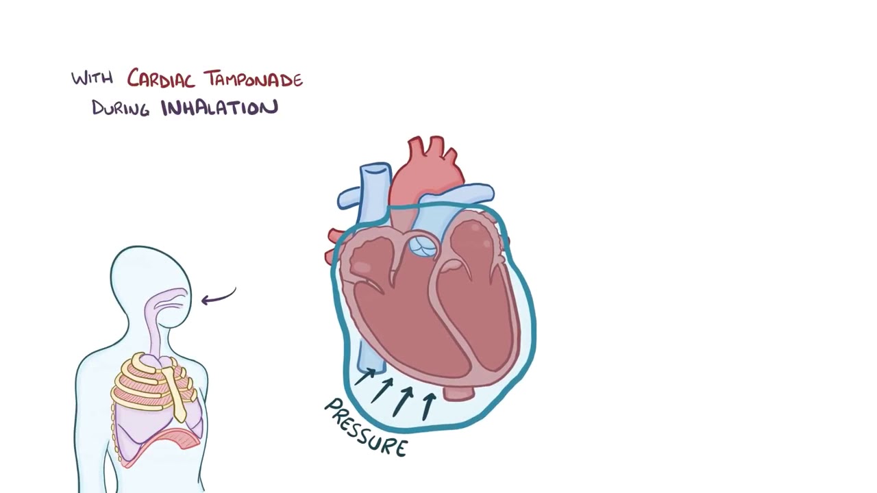 Cardiac Tamponade Pathophysiology cardiac-tamponade-pathophysiology