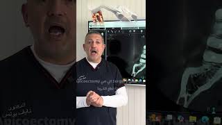 هل يجب اعادة علاج جذور الاسنان قبل جراحة قطع الذروة Apicectomy #apicectomy