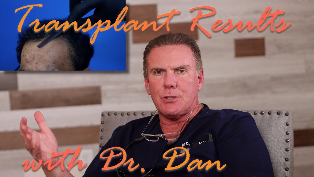 Norwood 5 Hair Transplant Results with Avinash - Indian Hair Loss Treatments