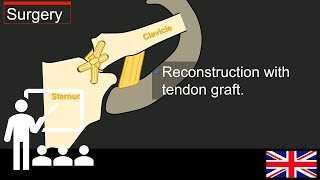 Trailer Lectures: Understanding sternoclavicular instability.