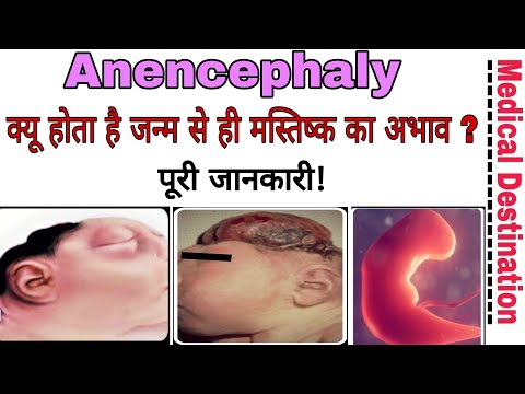 Anencephaly | Causes | Symptoms | Treatment | prevention in hindi | medical Destination  |