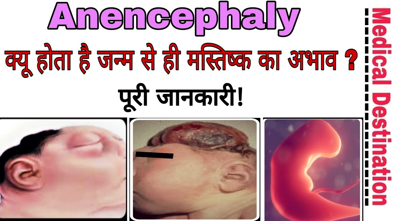 Meaning anencephaly What is