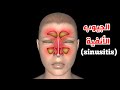 ماهو التهاب الجيوب الأنفية وكيف يتم علاجها What S Chronic Sinusitis 
