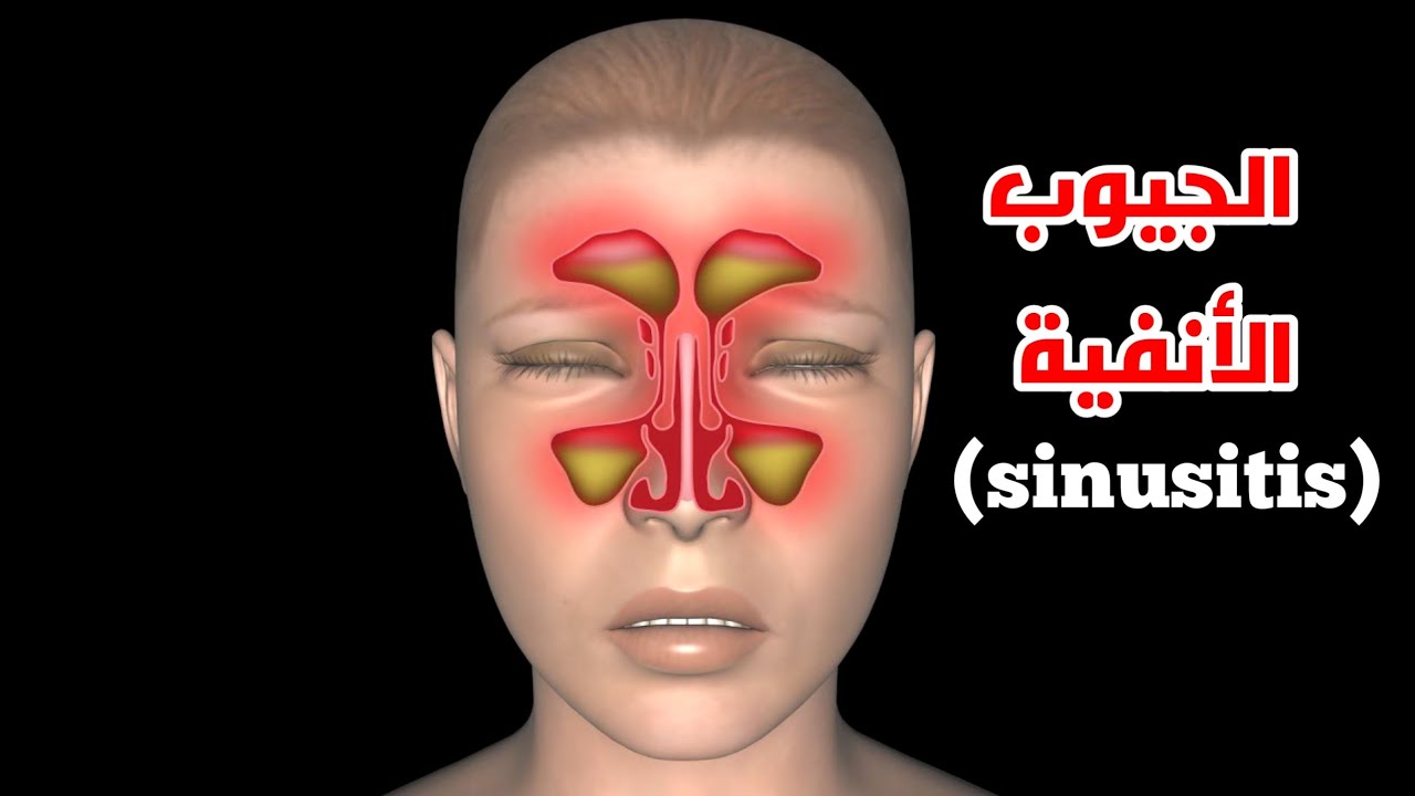 ماهو التهاب الجيوب الأنفية؟!وكيف يتم علاجها _ ?What’s Chronic Sinusitis