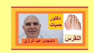 النقرس وسببه