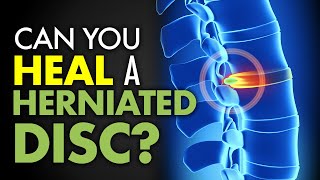 Can You Heal a Herniated Disc?