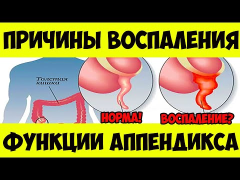 Зачем нам нужен АППЕНДИКС? Его функции и причины АППЕНДИЦИТА - воспаление аппендикса