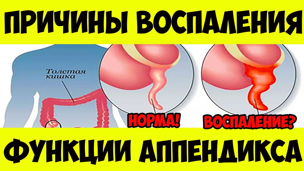 Зачем нам нужен АППЕНДИКС? Его функции и причины АППЕНДИЦИТА ...