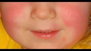 La fièvre scarlatine est de retour et tous les parents doivent faire attention... screenshot 4