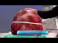 World’s Largest Fibroid Tumor!