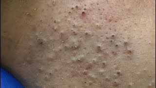 Advanced Blackhead Removal — Clear Complexion Solutions